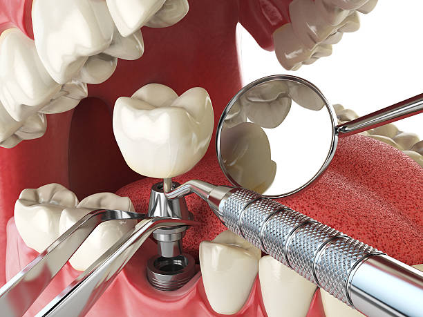 Best Emergency Treatment for Dental Infections or Abscesses in Green Tree, PA